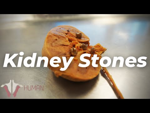 The Most PAINFUL Thing a Human Can Experience?? | Kidney Stones