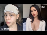 My Plastic Surgery journey Part 2 (Recovery & Results)