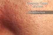 Types of Acne