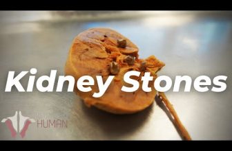 The Most PAINFUL Thing a Human Can Experience?? | Kidney Stones