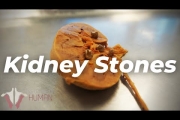 The Most PAINFUL Thing a Human Can Experience?? | Kidney Stones