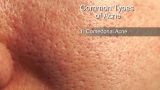 Types of Acne