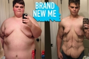 I Lost 230lbs And I’m Proud Of My Saggy Skin