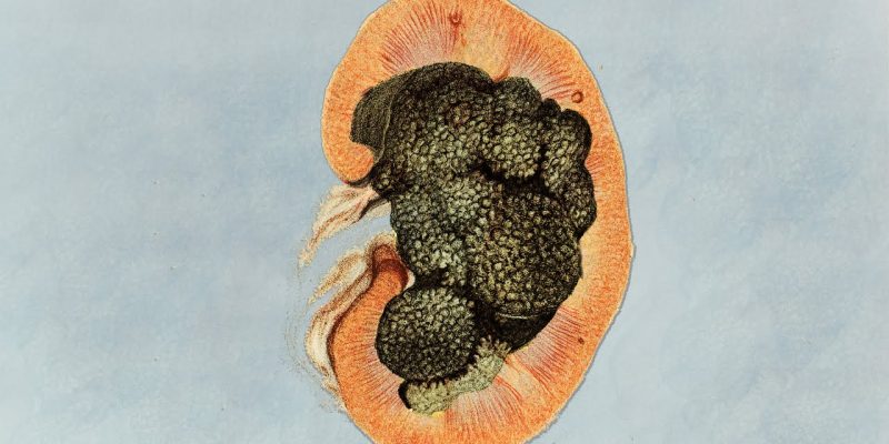 An Athlete Squatted 500 Reps In 20 Minutes – This Is What Happened To His Kidneys